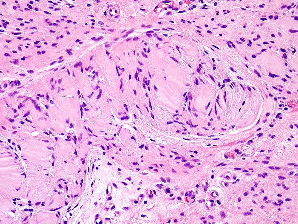 10B4 Neurofibroma, cutaneous, Meissner's (Case 10) H&E 1.jpg