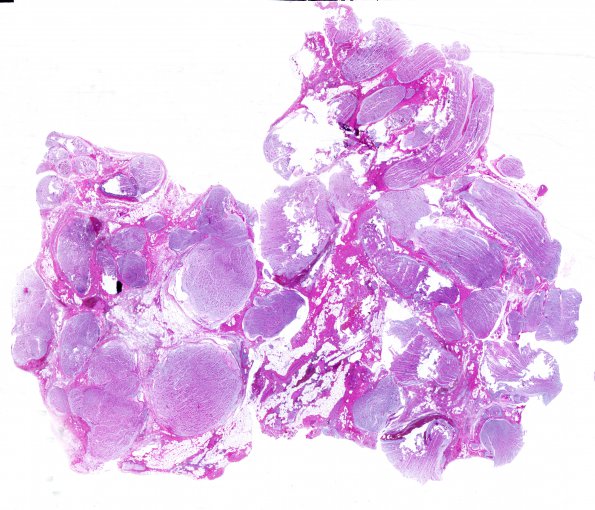 11A1 Neurofibroma, plexiform (Case 11) H&E whole mount