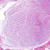 11A2 Neurofibroma, plexiform (Case 11) H&E 1