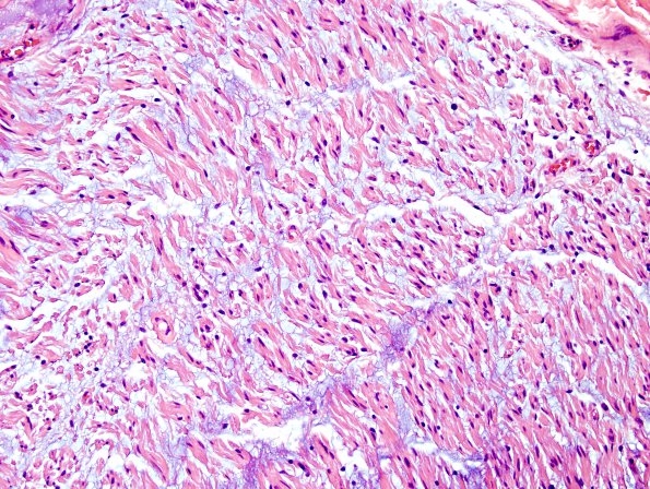 11A3 Neurofibroma, plexiform (Case 11) H&E 4