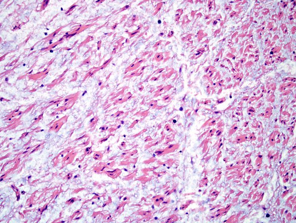 11A4 Neurofibroma, plexiform (Case 11) H&E 6