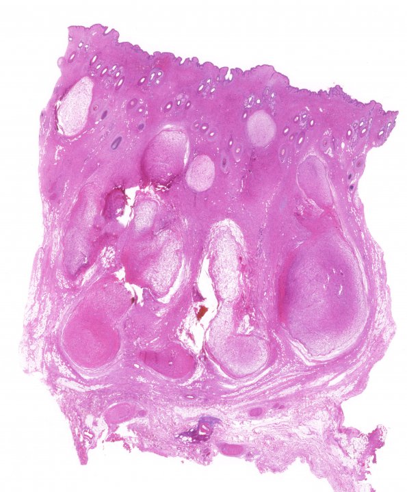 12A1 Neurofibroma, plexiform (Case 12) H&E whole mount