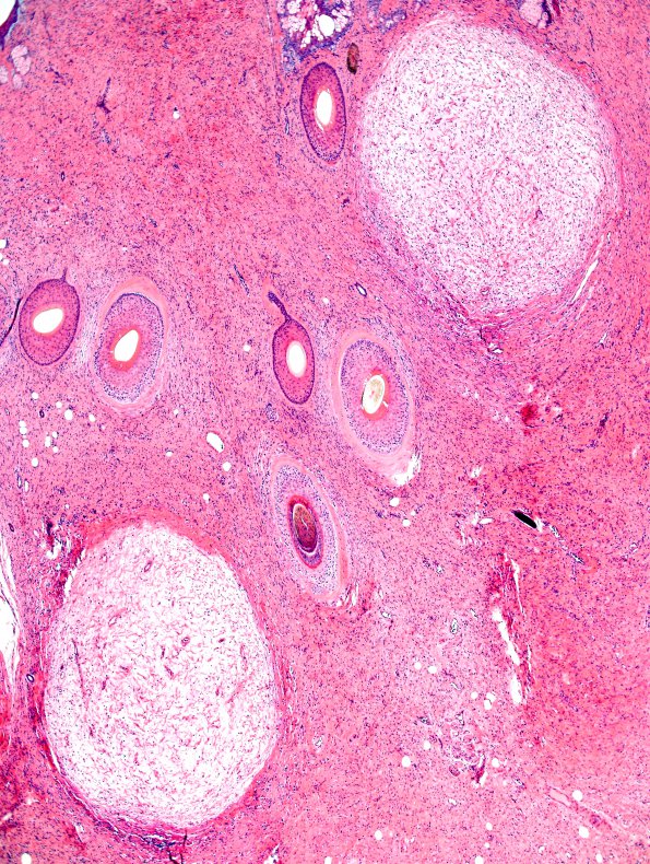 12A2 Neurofibroma, plexiform (Case 12) H&E 6.jpg