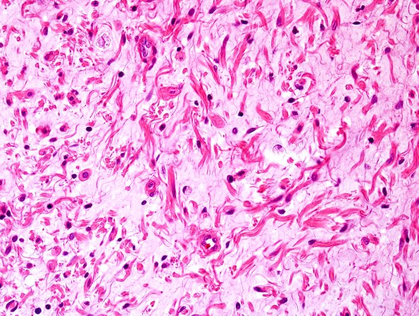 12A3 Neurofibroma, plexiform (Case 12) H&E 4.jpg