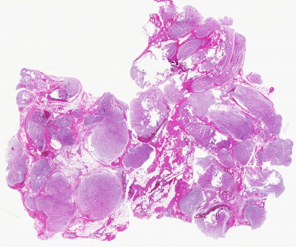 13A1 Neurofibroma, plexiform (Case 13) H&E whole mount