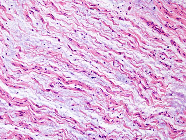 13A2 Neurofibroma, plexiform (Case 13) H&E 3