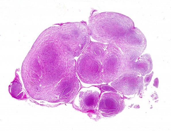 14A1 Neurofibroma, plexiform (Case 14) H&E whole mount 2