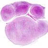 14A2 Neurofibroma, plexiform (Case 14) H&E whole mount 1