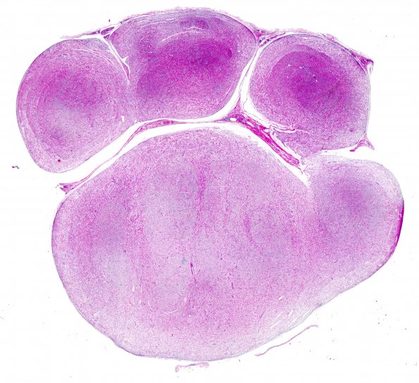 14A2 Neurofibroma, plexiform (Case 14) H&E whole mount 1