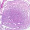 14A3 Neurofibroma, plexiform (Case 14) H&E 5