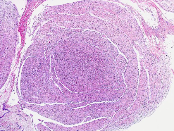 14A3 Neurofibroma, plexiform (Case 14) H&E 5