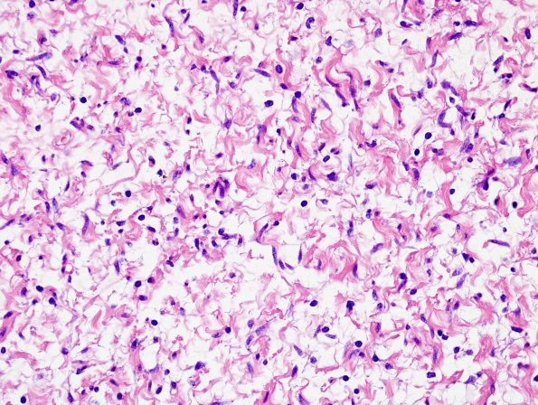 14A4 Neurofibroma, plexiform (Case 14) H&E 3