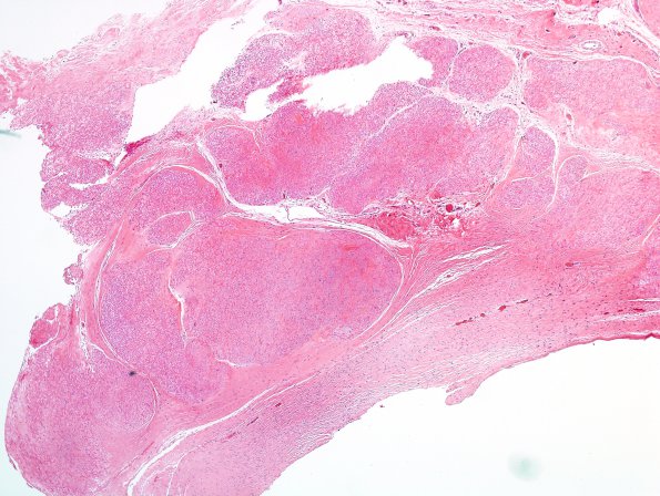 15 Neurofibroma, plexiform, hyalinized (Case 15) H&E 1