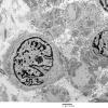 16A1 Neurofibroma, plexiform 014 - (Case 16) Copy