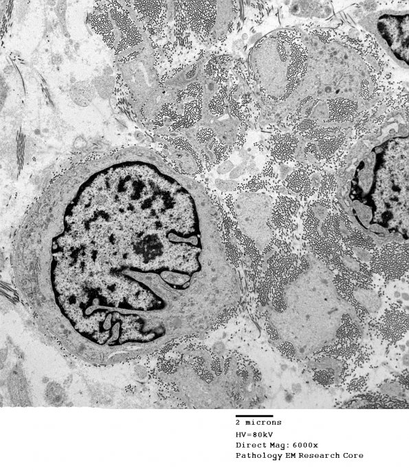 16A1 Neurofibroma, plexiform 014 - (Case 16) Copy