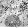 16A10 Neurofibroma, plexiform 034 - (Case 16) Copy