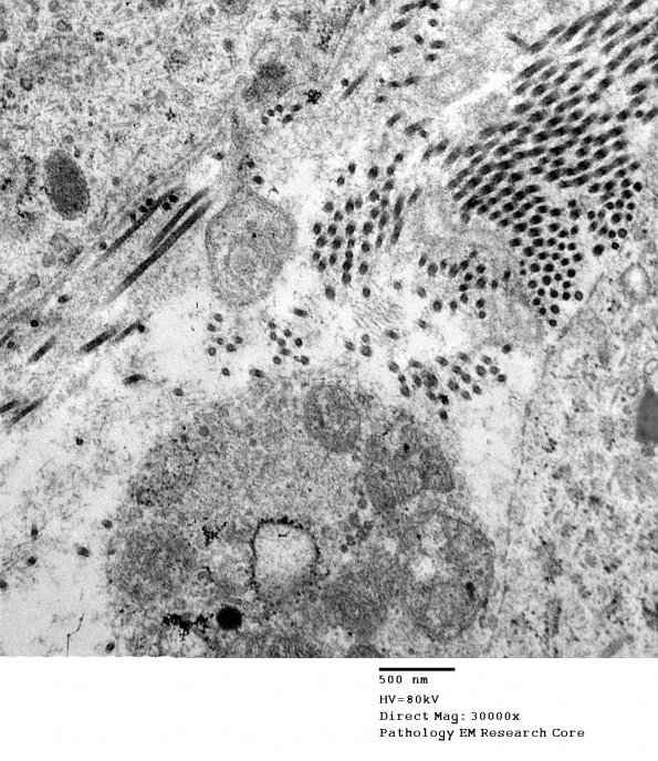 16A10 Neurofibroma, plexiform 034 - (Case 16) Copy