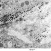 16A11 Neurofibroma, plexiform 035 - (Case 16) Copy