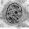 16A2 Neurofibroma, plexiform 16 - (Case 16) Copy - Copy