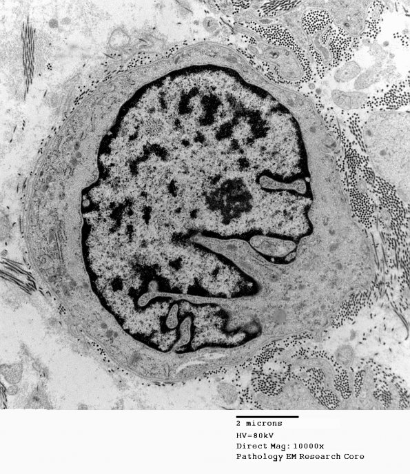 16A2 Neurofibroma, plexiform 16 - (Case 16) Copy - Copy