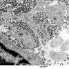 16A3 Neurofibroma, plexiform 18 - (Case 16) Copy