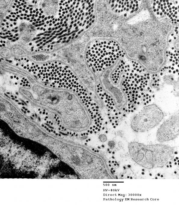 16A3 Neurofibroma, plexiform 18 - (Case 16) Copy