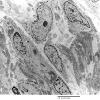 16A4 Neurofibroma, plexiform 025 - (Case 16) Copy