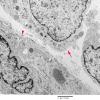 16A5 Neurofibroma, plexiform 027 (Case 16) copy - Copy (2)