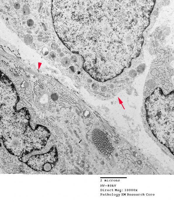 16A5 Neurofibroma, plexiform 027 (Case 16) copy - Copy (2)