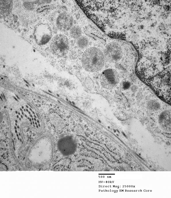 16A6 Neurofibroma, plexiform 028 - Copy