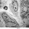 16A7 Neurofibroma, plexiform 29 - (Case 16) Copy