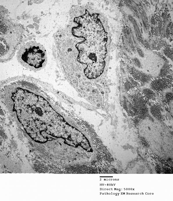 16A7 Neurofibroma, plexiform 29 - (Case 16) Copy