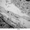 16A8 Neurofibroma, plexiform 030 - (Case 16) Copy