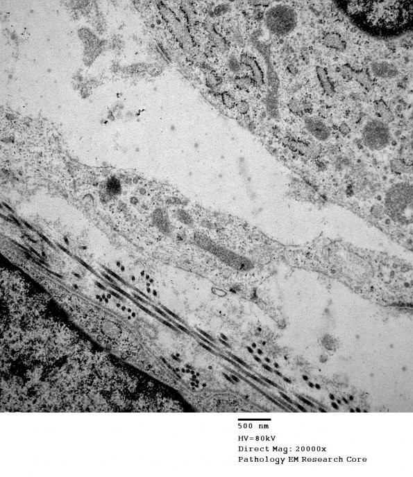 16A8 Neurofibroma, plexiform 030 - (Case 16) Copy