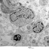 16A9 Neurofibroma, plexiform 032 - (Case 16) Copy