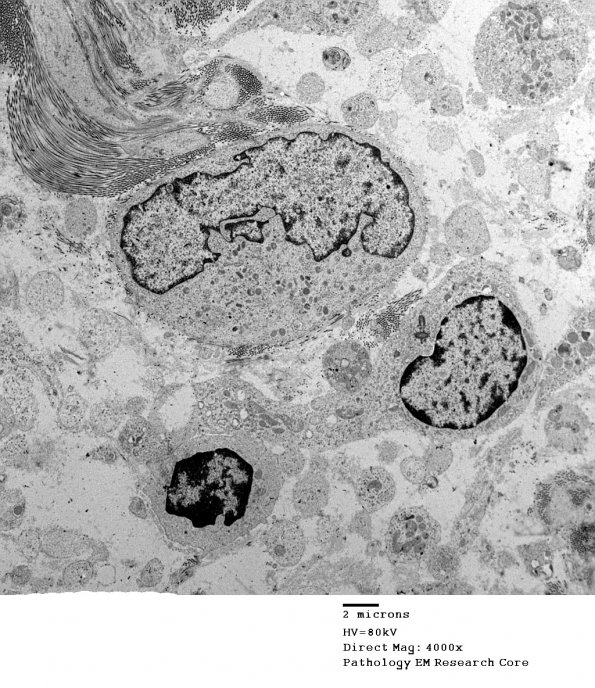 16A9 Neurofibroma, plexiform 032 - (Case 16) Copy