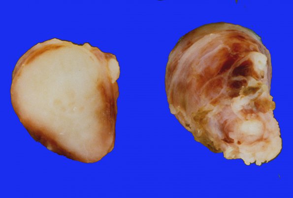 18A1 Neurofibroma, plexiform (Case 18) gross 1