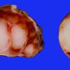 18A2 Neurofibroma, plexiform (Case 18) gross 3