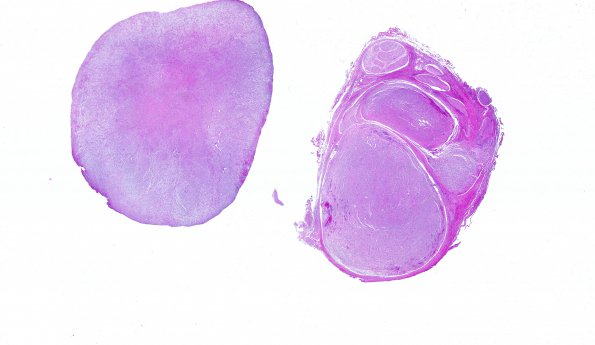 18B1 Neurofibroma, plexiform (Case 18)