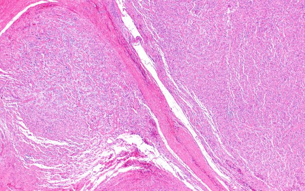 18B2  Neurofibroma, plexiform (Case 18) 4X