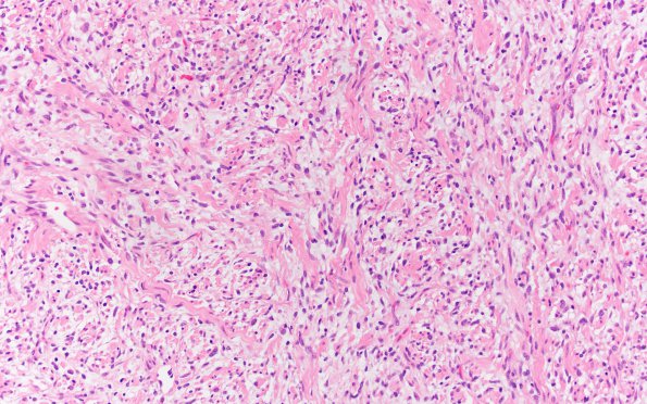 18B3 Neurofibroma, plexiform (Case 18) 20X 2