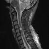 1A1 Neurofibroma, NF1 patient (Case 1) STIR - Copy