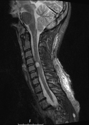 1A1 Neurofibroma, NF1 patient (Case 1) STIR - Copy