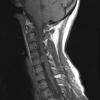 1A2 Neurofibroma, NF1 patient (Case 1) T1noC - Copy