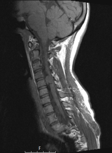 1A2 Neurofibroma, NF1 patient (Case 1) T1noC - Copy