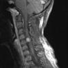 1A3 Neurofibroma, NF1 patient (Case 1) T1W 2 - Copy