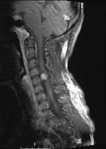 1A3 Neurofibroma, NF1 patient (Case 1) T1W 2 - Copy