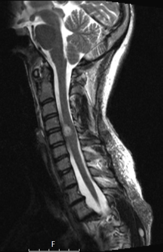 1A4 Neurofibroma, NF1 patient (Case 1) T2 - Copy