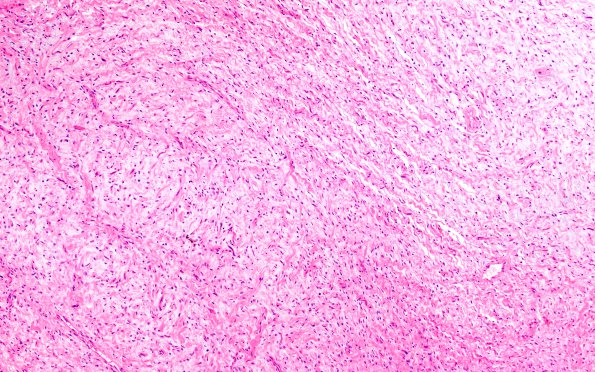 1B1 Neurofibroma, NF1 patient (Case 1) H&E 2