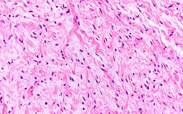 1B2 Neurofibroma, NF1 patient (Case 1) H&E 3